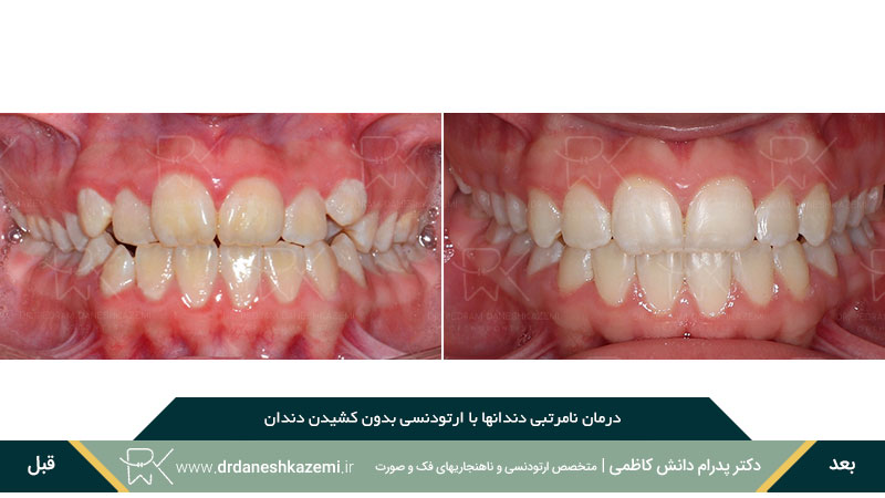 عکس قبل و بعد ارتودنسی دندانهای بالا و پایین روبرو