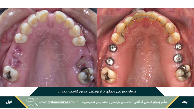 رفع نامرتبی دندانهای فک بالا توسط ارتودنسی