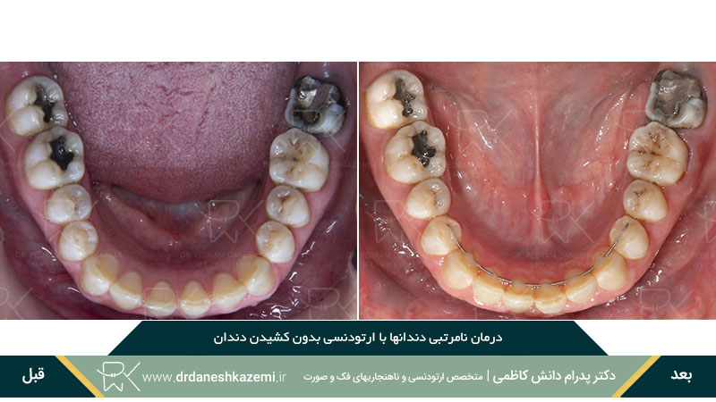 رفع نامرتبی دندانهای فک پائین توسط ارتودنسی