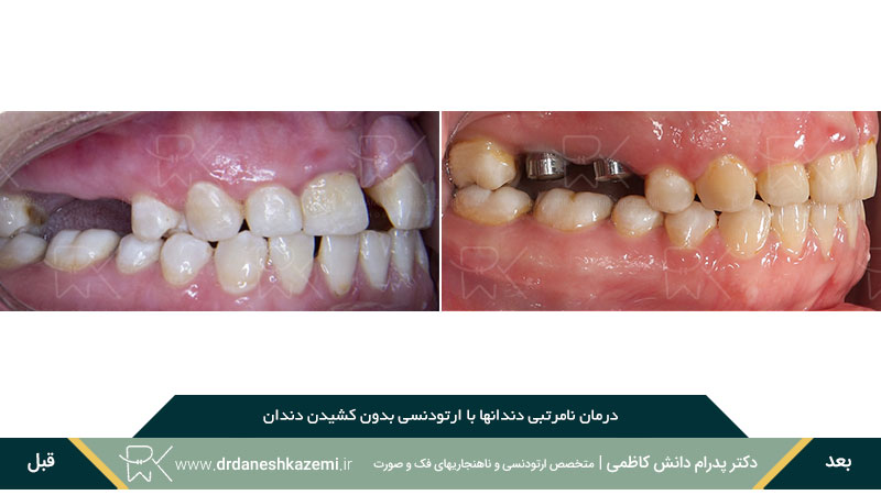 نمای بسته سمت راست ارتودنسی دندانها