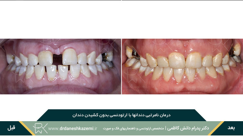 ارتودنسی دندانهای نامرتب و فاصله دار نمای روبرو