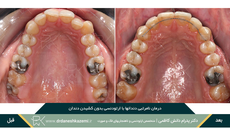 ارتودنسی برای رفع نامرتبی دندانهای فک بالا