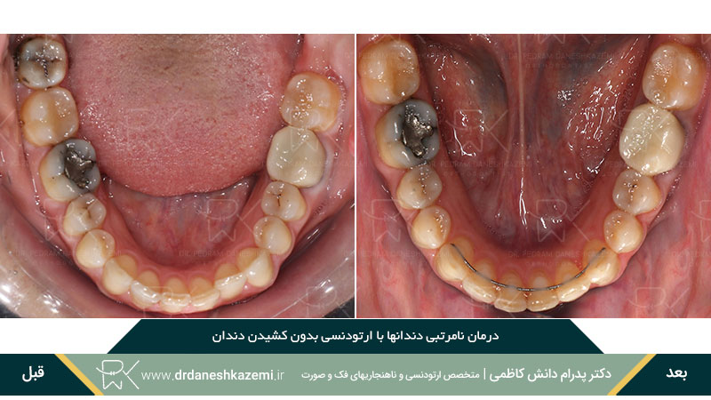 ارتودنسی برای رفع نامرتبی دندان های فک پائین