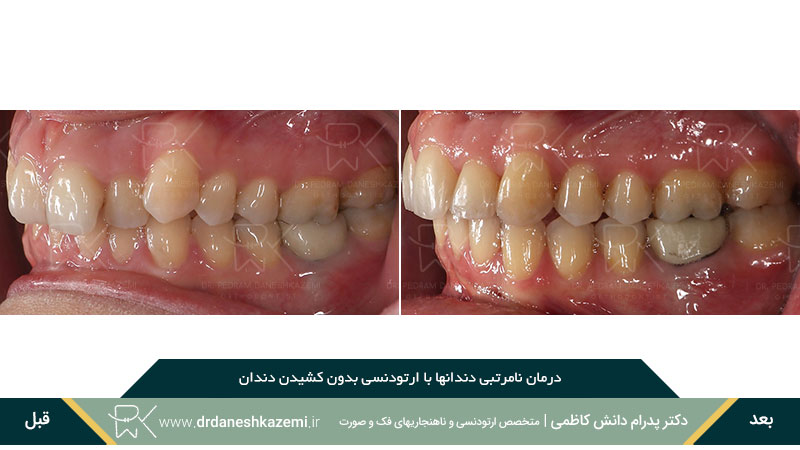 ارتودنسی دندانهای سمت چپ فک بالا و پایین