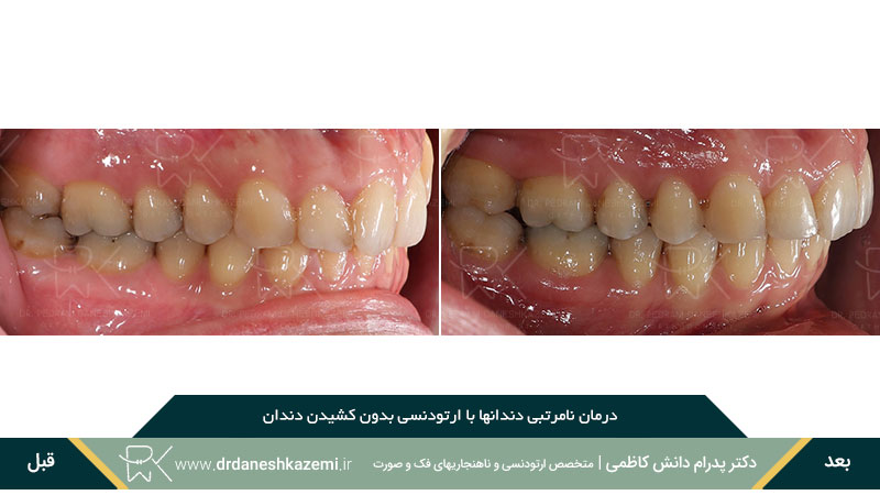 ارتودنسی دندانهای  سمت راست فک بالا و پایین