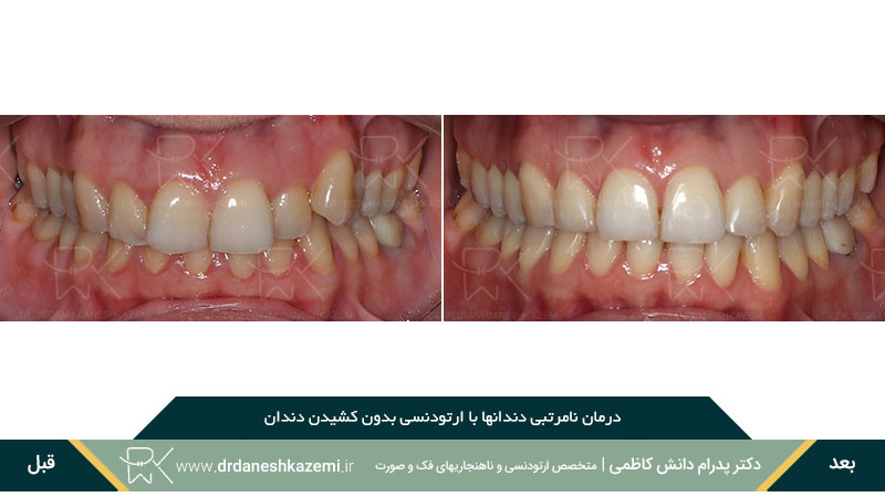 مرتب سازی دندان ها با ارتودنسی (نمای روبرو)