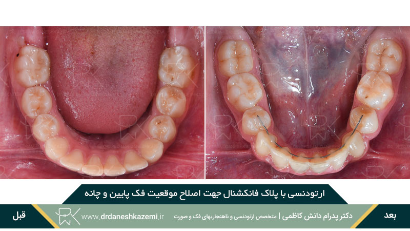 ارتودنسی با پلاک فانکشنال فک پائین