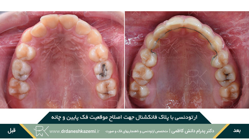 ارتودنسی با پلاک فانکشنال فک بالا