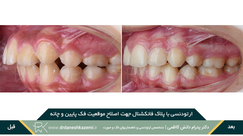 ارتودنسی با پلاک فانکشنال (نمای نیم رخ)