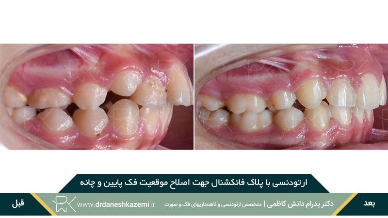 ارتودنسی با پلاک فانکشنال (نمای نیم رخ)