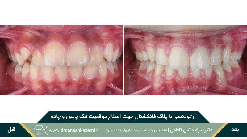 ارتودنسی با پلاک فانکشنال (نمای روبرو)