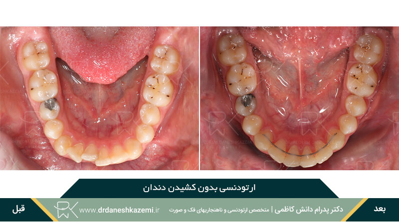 ارتودنسی فک پائین بدون کشیدن دندان