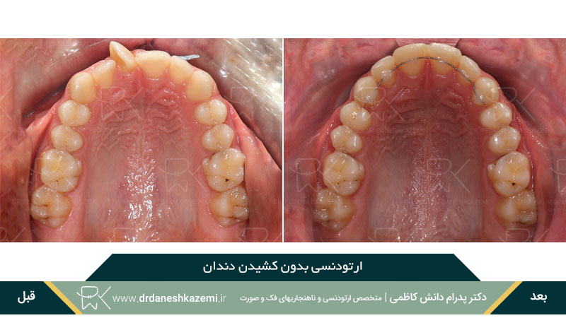 ارتودنسی فک بالا بدون کشیدن دندان