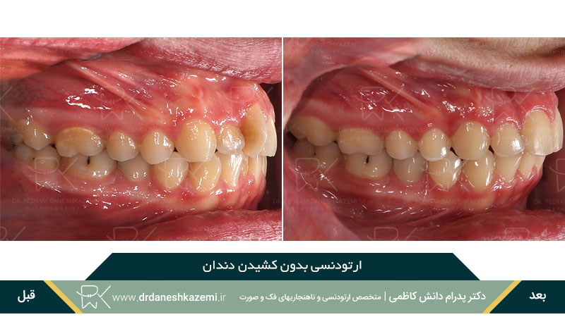 ارتودنسی بدون کشیدن دندان (نیم رخ)
