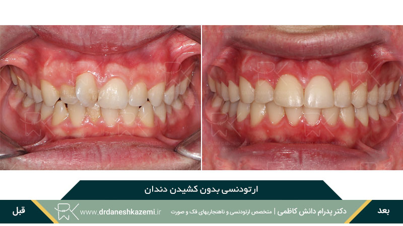 ارتودنسی بدون کشیدن دندان (نمای روبرو)