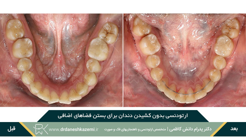 ارتودنسی بدون کشیدن دندان برای رفع فاصله اضافی