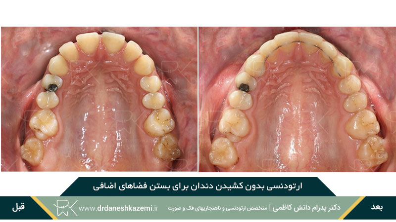 ارتودنسی بدون کشیدن دندان برای رفع فاصله اضافی