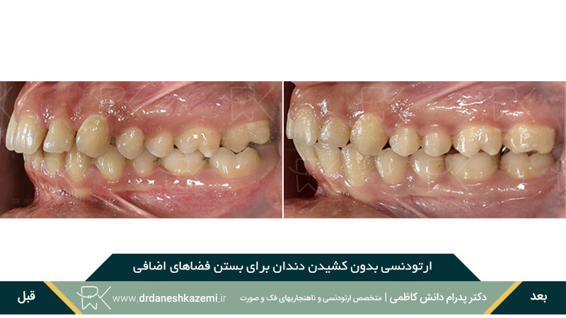 ارتودنسی بدون کشیدن دندان برای رفع فاصله اضافی