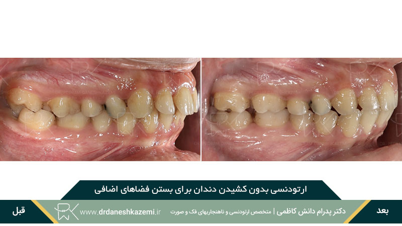 ارتودنسی بدون کشیدن دندان برای رفع فاصله اضافی