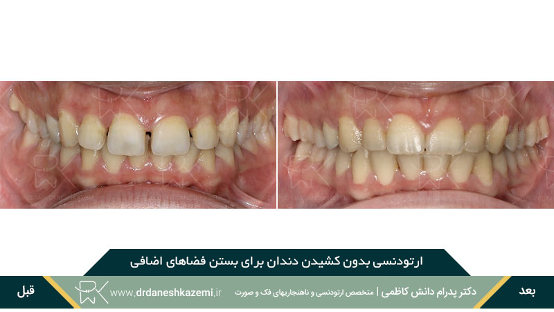 ارتودنسی بدون کشیدن دندان برای رفع فاصله اضافی