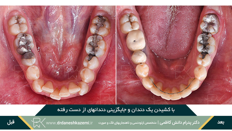 با کشیدن یک دندان و جایگزینی دندانهای از دست رفته