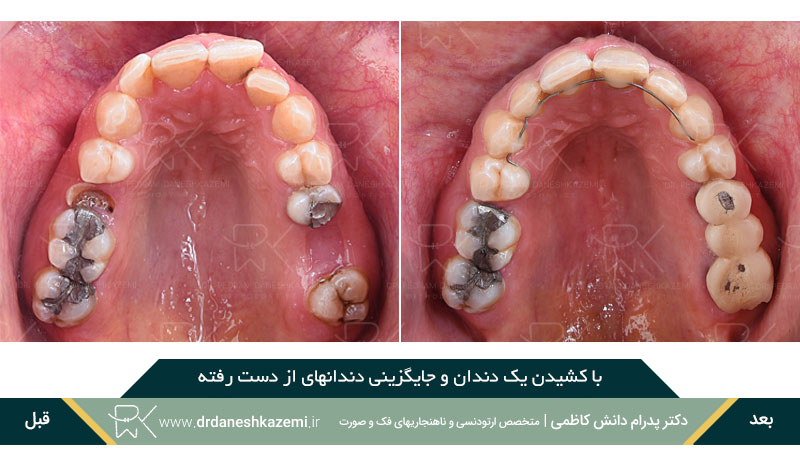 با کشیدن یک دندان و جایگزینی دندانهای از دست رفته