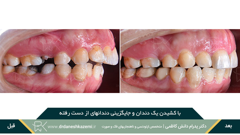 با کشیدن یک دندان و جایگزینی دندانهای از دست رفته