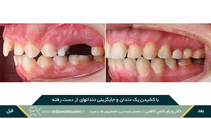 با کشیدن یک دندان و جایگزینی دندانهای از دست رفته