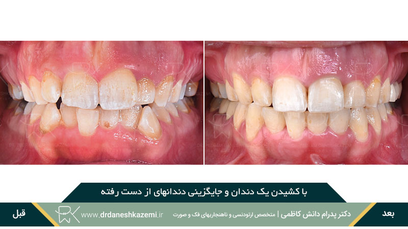 با کشیدن یک دندان و جایگزینی دندانهای از دست رفته