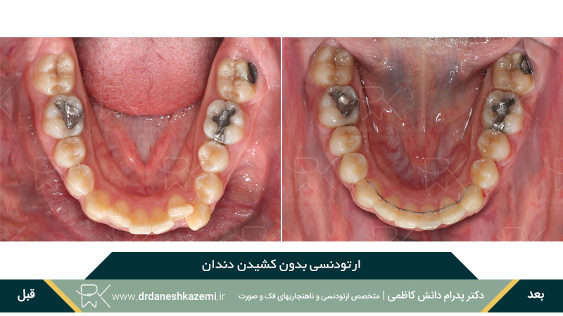 ارتودنسی بدون نیاز به کشیدن دندان