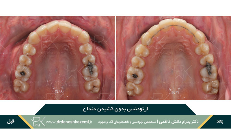 ارتودنسی بدون نیاز به کشیدن دندان