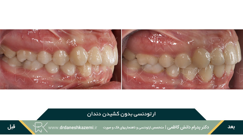 ارتودنسی بدون نیاز به کشیدن دندان