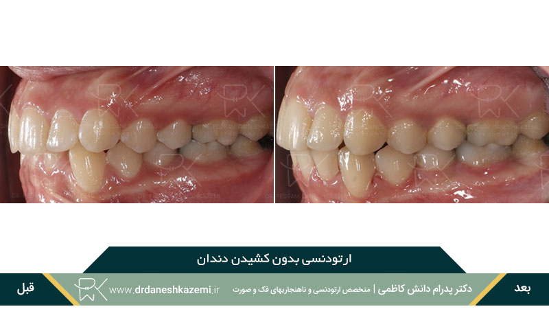 ارتودنسی بدون نیاز به کشیدن دندان