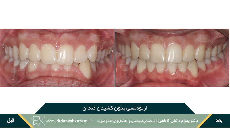 ارتودنسی بدون نیاز به کشیدن دندان