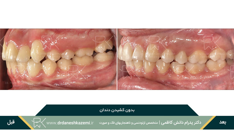 نمونه ارتودنسی بدون کشیدن دندان