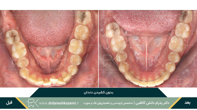 نمونه ارتودنسی بدون کشیدن دندان