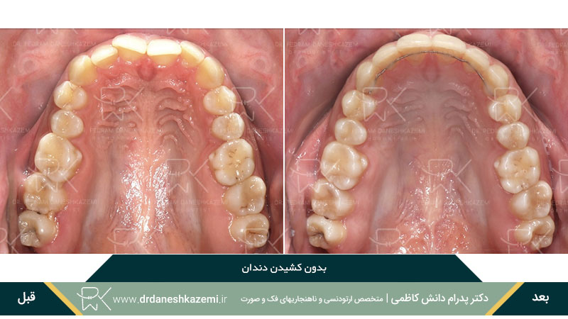 نمونه ارتودنسی بدون کشیدن دندان