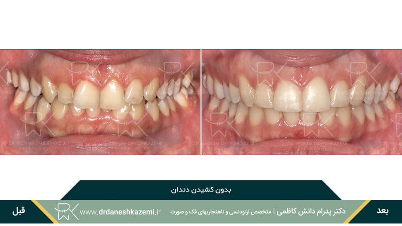 نمونه ارتودنسی بدون کشیدن دندان