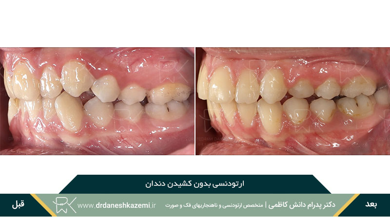 عکس قبل و بعد ارتودنسی بدون کشیدن دندان