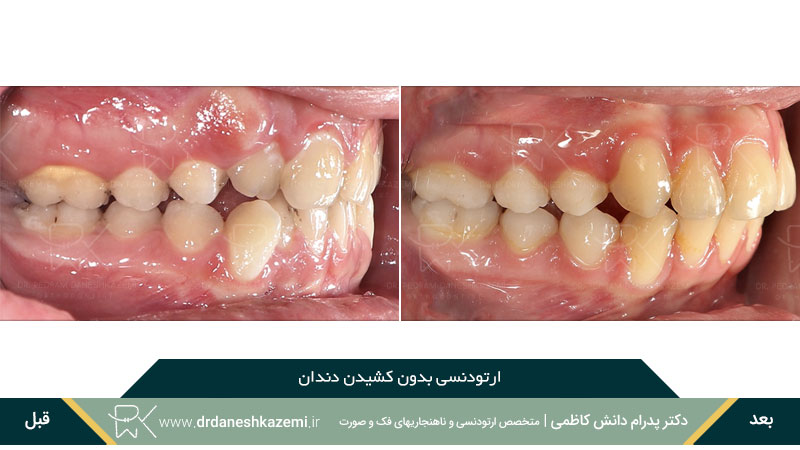 عکس قبل و بعد ارتودنسی بدون کشیدن دندان