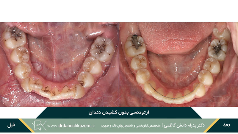 عکس قبل و بعد ارتودنسی بدون کشیدن دندان