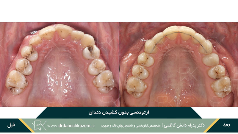 عکس قبل و بعد ارتودنسی بدون کشیدن دندان