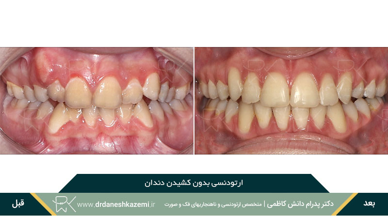 عکس قبل و بعد ارتودنسی بدون کشیدن دندان