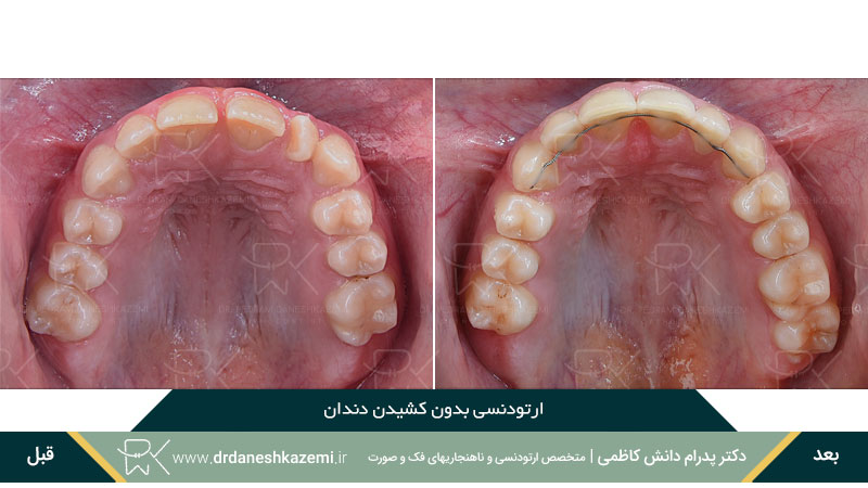 انجام ارتودنسی بدون کشیدن دندان