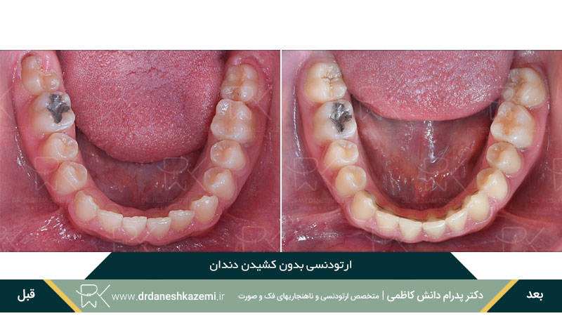 انجام ارتودنسی بدون کشیدن دندان