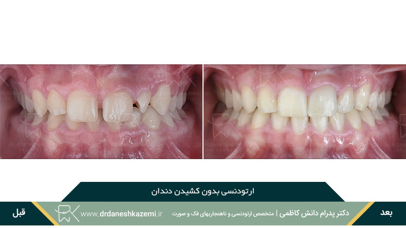 انجام ارتودنسی بدون کشیدن دندان