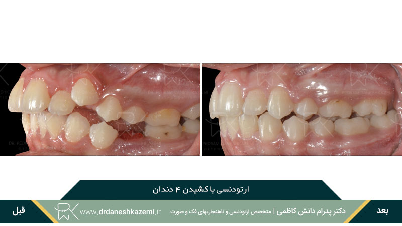 نمونه قبل و بعد ارتودنسی با کشیدن چهار دندان