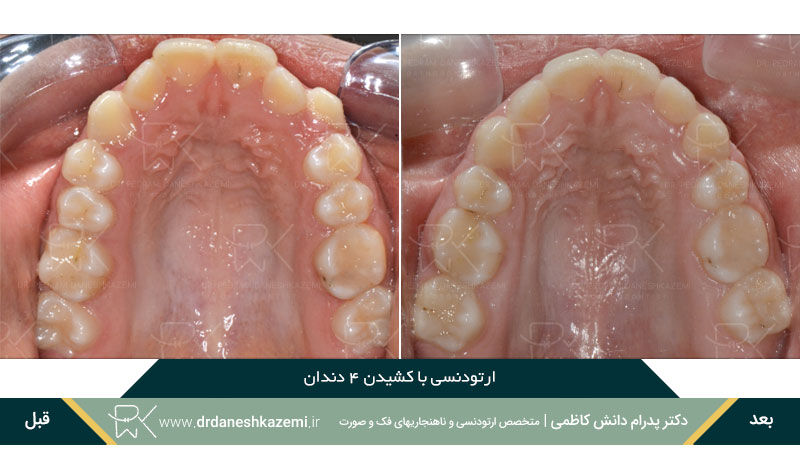 نمونه قبل و بعد ارتودنسی با کشیدن چهار دندان