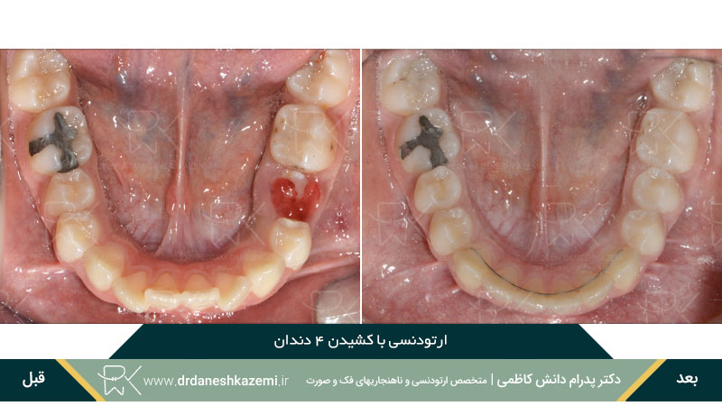 نمونه قبل و بعد ارتودنسی با کشیدن چهار دندان