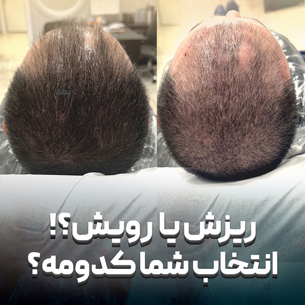 عکس قبل و بعد درمان ریزش مو 